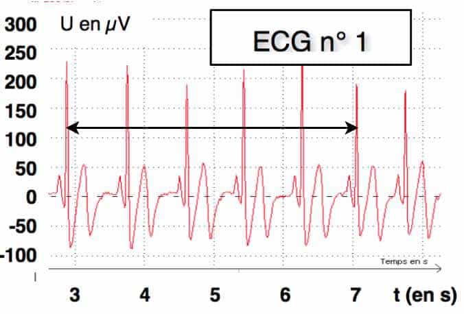 Graphique d'un électrocardiogramme en plein effort
