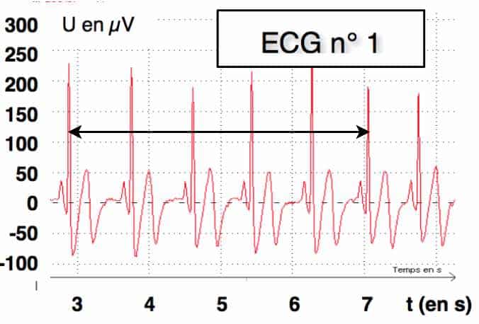 Graphique d'un électrocardiogramme en plein effort